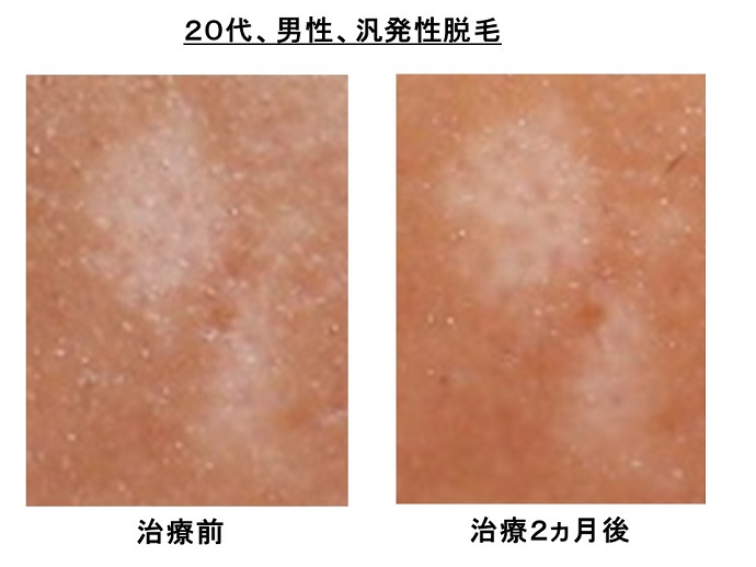 円形脱毛症　病院